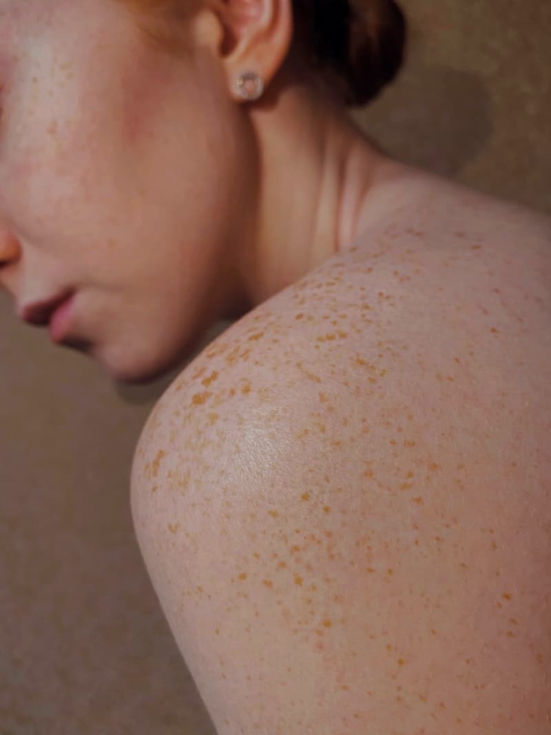 Skin Cancer Screening